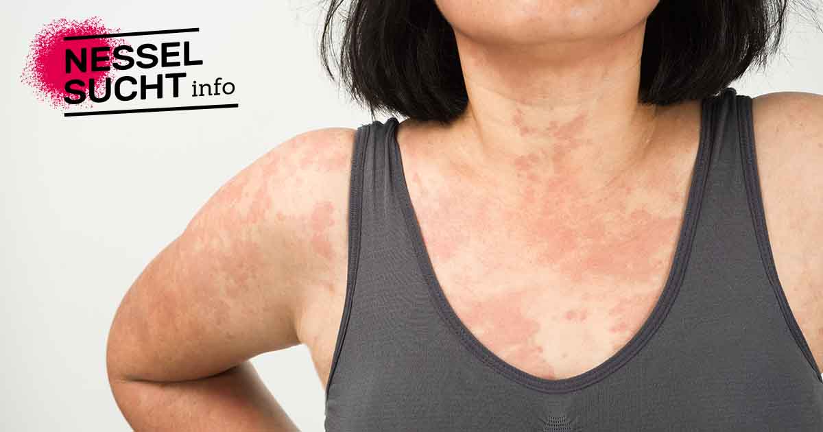 Praktische Tools bei Nesselsucht | nesselsuchtinfo.de