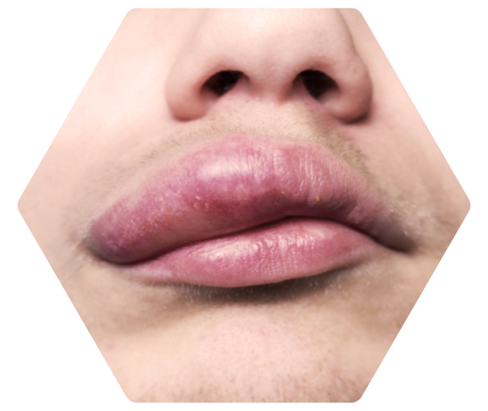 Bildausschnitt einer Nase und eines Munds mit geschwollener Oberlippe.