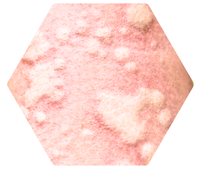 Hautbereich mit unterschiedlich großen Quaddeln.