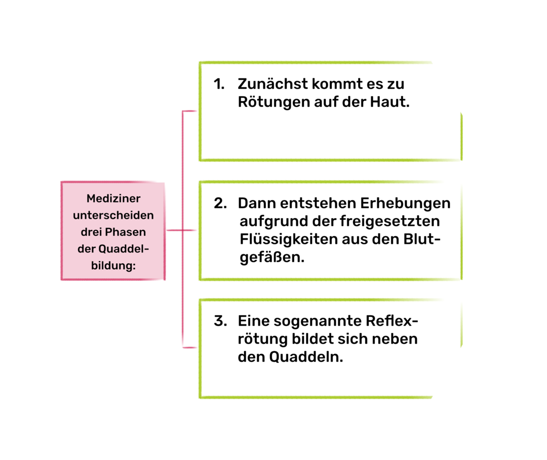 Nesselsucht-Symptome: Infografik Quaddelbildung Die Infografik erklärt die drei Phasen der Quaddelbildung: Rötungen auf der Haut, Erhebungen und Reflexrötungen neben den Quaddeln.